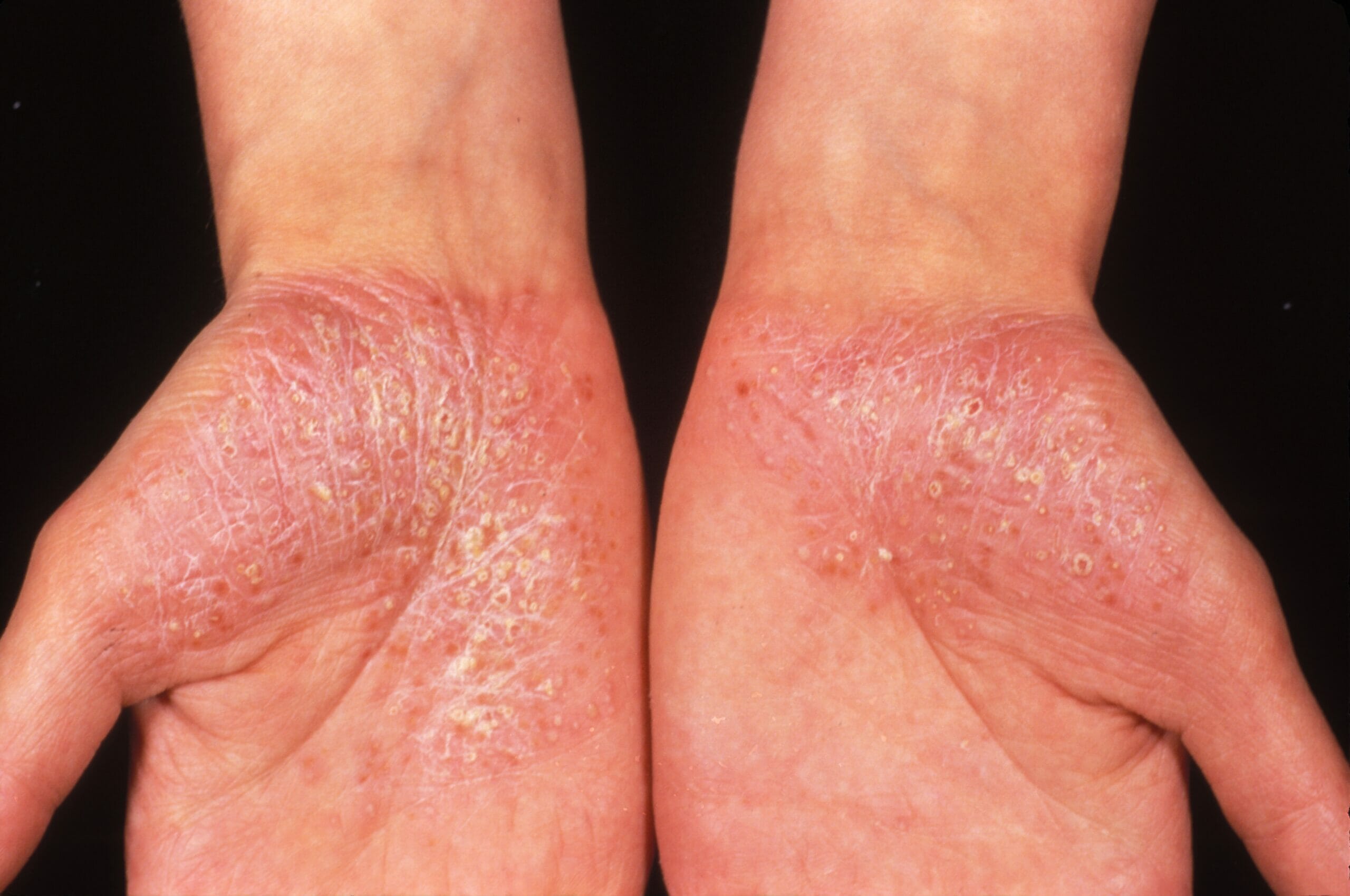 What is Generalized Pustular Psoriasis AKA GPP?