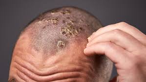 Scalp Psoriasis