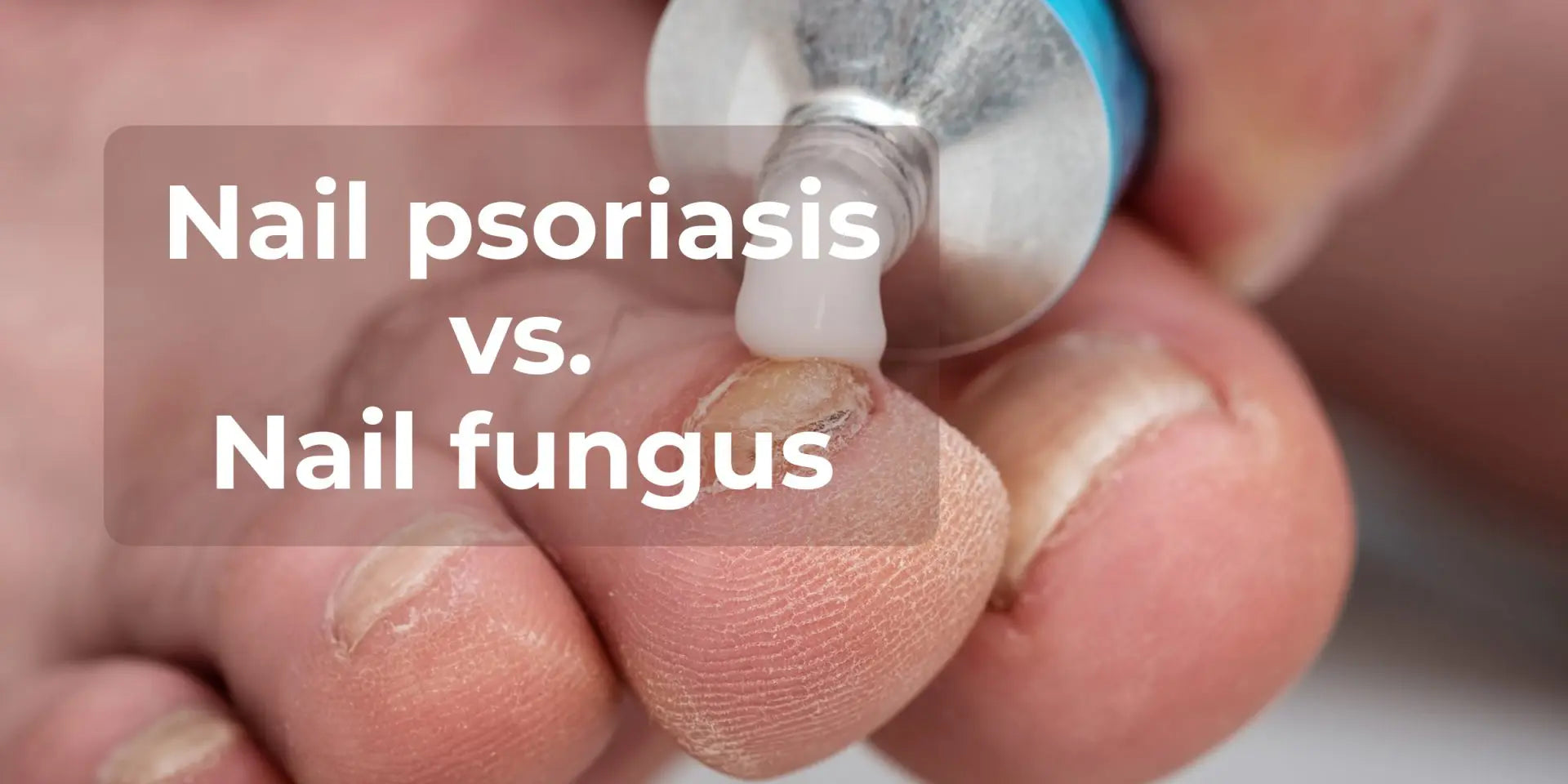 Nail Psoriasis Vs Fungus What Are The Differences Uvbmedi 0423